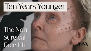 NonSurgical Facelift with Dermal Fillers ❇️ Look 10 Years Younger without Surgery [upl. by Verger]