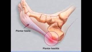 Best Exercise For Plantar Fasciitis Treatment [upl. by Ainnos]