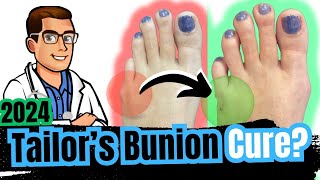 Bunionette Tailors Bunion Surgery Corrector Splints amp Treatment [upl. by Ema]