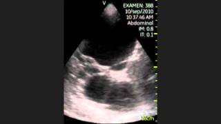 Vscan Polycystic kidney Pocket Ultrasound Poliquistosis renal [upl. by Margret]