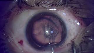 Managing a subluxated cataract CTR to the rescue [upl. by Oreves762]