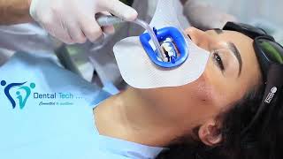 Globodent BlanQuest® Pro Instructional Video Professional In Office Teeth Whitening by Dental Tech [upl. by Trebmal]