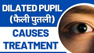 Dilated Pupil फैली हुई पुतली Causes and Treatment [upl. by Eustace845]