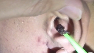 Mans Dark Giant Earwax Removal [upl. by Tullus]