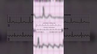 Atrial fibrillation vs Atrial flutter  Medicos  Cardiology [upl. by Conners]