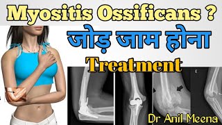 elbow stiffness treatment  myositis ossificans treatment  myositis ossificans exercises  in hindi [upl. by Bidle]