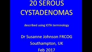 serous cystadenomas YouTube Feb 2017 [upl. by Einned]