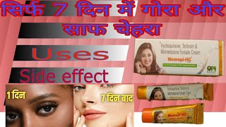 MemopiHC Cream Uses In Hindi  Hydroquinone Tretinoin Mometasone Furoate Cream Benefits amp Side E [upl. by Nahem98]