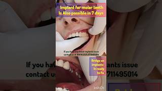 Now molar basal Implants are possibleget teeth in just 5 days basalimplants [upl. by Rep375]