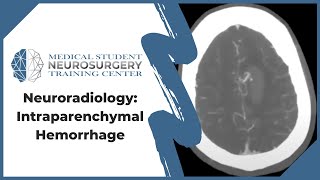 Neuroradiology Intraparenchymal Hemorrhage [upl. by Song]