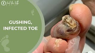 Gushing Infected Toe [upl. by Lucias]