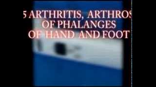 15 ARTHRITIS ARTHROSIS OF PHALANGES OF HAND AND FOOT [upl. by Martino682]