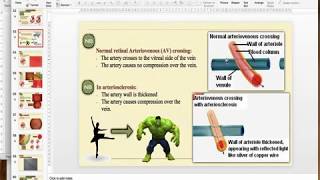 Hypertensive Retinopathy [upl. by Wearing409]