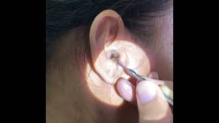 Removing Womans Giant Earwax Using An Ear Curette [upl. by Oicaroh]