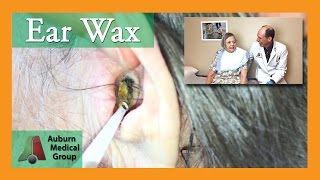 Ear Wax Removal for Hearing Aids  Auburn Medical Group [upl. by Roht]