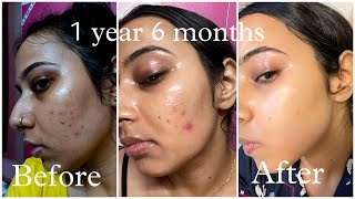 Pimples Removal Journey  Tretinoin before and after  all unfiltered photos and videos [upl. by Walley]