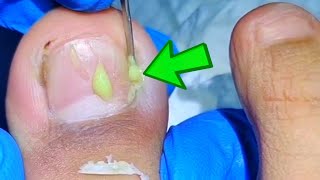 WARNING Ingrown Toenail Mistakes That Can LEAD TO INFECTION [upl. by Dart850]