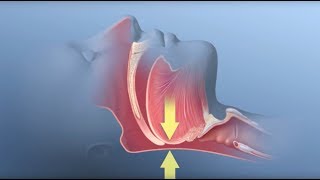 Obstructive Sleep Apnea  Mayo Clinic [upl. by Vullo]