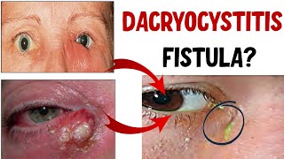 DACRYOCYSTITIS Lacrimal Sac Infection Stages Complications and Treatment [upl. by Danie]