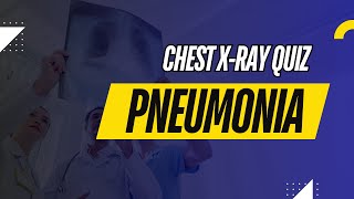 Pneumonia Chest Xray Quiz [upl. by Aicarg525]