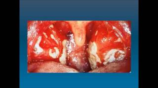 Mononucleosis infecciosa Enfermedad del beso [upl. by Euell]