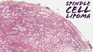 Spindle Cell Lipoma 5Minute Pathology Pearls [upl. by Suckram527]