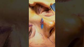 How Its Done Upper and Lower Eyelid Surgery with Dr Kami Parsa [upl. by Aarika]