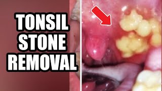 Tonsils Stone Removal Causes amp Treatment 2021 [upl. by Araj300]