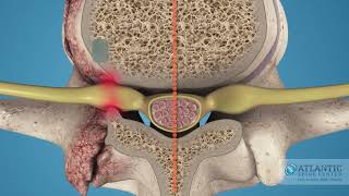 What is Cervical Lateral Stenosis AtlanticSpineCenter [upl. by Aciretnahs]