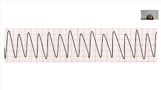 Ventricular Tachycardia [upl. by Barny]