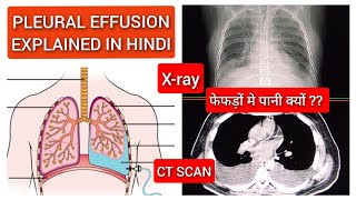 Pleural Effusion  फेफड़ों में क्यों भर जाता है पानी   Pleural Effusion CT Scan Lungs Explained [upl. by Artened]