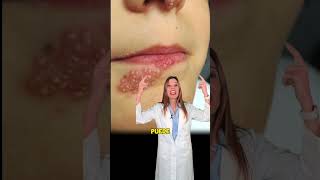 HERPES O CALENTURAS MEJOR TRATAMIENTO SEGÚN DERMATÓLOGA 🦠 piel herpes calenturas virus [upl. by Yerffoeg]