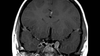 Neurofibromatosis Type 2 [upl. by Tabina374]