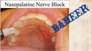 nasopalatine nerve block [upl. by Ned]