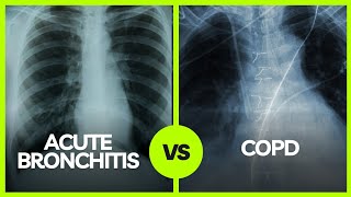 Understanding the Differences Acute Bronchitis vs COPD  Medical Insights [upl. by Manon]