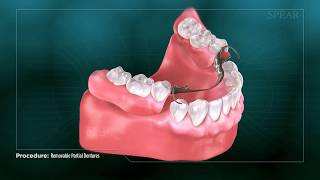 Removable Dentures [upl. by Amil]