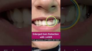 ENLARGED Gum Reduction with LASER Dr Srishti Bhatia smilemakeover smile [upl. by Haimerej]