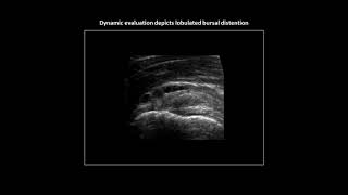 Lobulated subacromialsubdeltoid bursitis on shoulder ultrasound [upl. by Haliek]