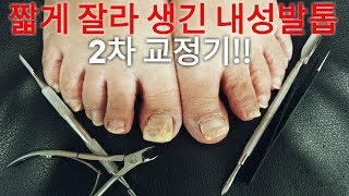 시원함주의 짧게 잘라서 생긴 내성발톱 2차 교정기 너무 많이 펴졌어요 끝까지 보세요 [upl. by Hastie]