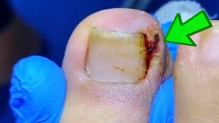 Patients Big Toenail Is Badly Infected Ingrown Toenail Removal ASMR Satisfying [upl. by Kcirtapnhoj]