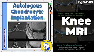 Fig 5C09 MRI Findings of Autologous Chondrocyte Implantation [upl. by Naved483]