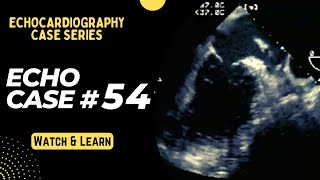 Echocardiography Case 54 Echo Spot Diagnosis Series  Cardiology  Transesophageal Echocardiogram [upl. by Nospmas524]