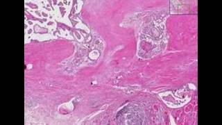 Histopathology ThyroidHashimoto thyroiditis papillary car [upl. by Corso93]