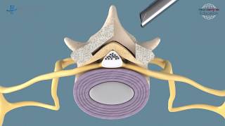 Spinal Stenosis  Fullendoscopic decompression at the lumbar spine with VERTEBRIS stenosis [upl. by Tdnerb]