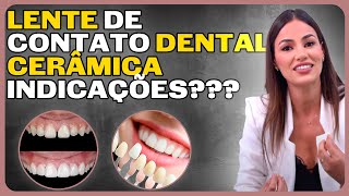 ETAPAS E INDICAÇÕES de LENTE DE CONTATO DENTAL EM CERÂMICA [upl. by Allimac920]