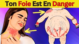 Maladie du foie gras  10 conseils vitaux pour protéger votre santé [upl. by Adlee]