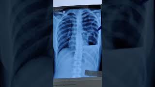 HOW TO DESCRIBE CHEST XRAY OF HYDROPNEUMOTHORAX PNEUMOTHORAX PLEURAL EFFUSIONchestxray ytshorts [upl. by Byrd374]