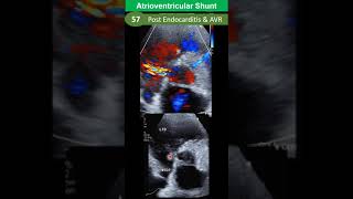 Atrioventricular Shunt Post Endocarditis amp AVR [upl. by Grimbal557]