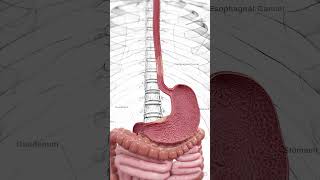 🔬 Understanding Esophageal Cancer Early Detection Is Key 🔬 anatomy [upl. by Verner]