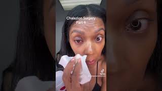 Chalazion surgery Part 4 chalazion surgeryday eyedoctor eyesurgery stye [upl. by Apollo12]